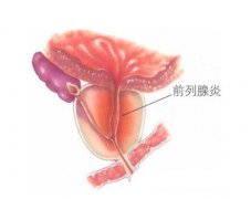 出现3个症状可能就是前列腺囊肿来袭